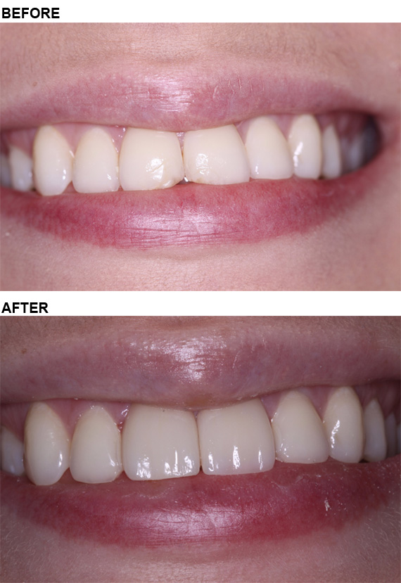 This is a case just completed that replaces old failing bonding and chipped front teeth with beautiful porcelain veneers.